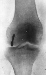 8a. ábra 8b. ábra A femur laterális condylus osteochondralis törésének rögzítése Herbert-csavarokkal. A 8a. AP a 8b.