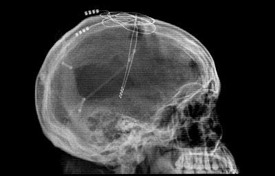 Parkinson-kór) - kórosan alulműködő területek ingerlése (pl. koma, depresszió) Érdekes videólippek: http://www.