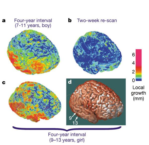 A fejlődő agy növekedési mintázata 7-11 év (fiú) 2 hetes