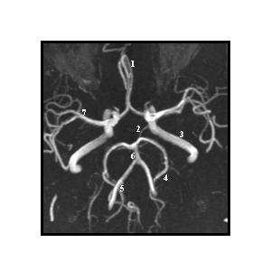 Anatómiai struktúrák ( A kép): 1 vena (media) superficialis cerebri 2 sinus sagittalis superior 3 vena magna cerebri 4 venae superficiales cerebri 5 sinus sagittalis inferior 5 B.