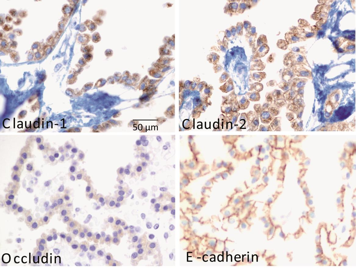 (claudin-1,-2,-7), occludin és az E-cadherin fehérjék immunhisztokémiai vizsgálata is megtörtént, mind az egészséges choroid plexus epitheliumban, mind szupratentoriális és infratentoriális