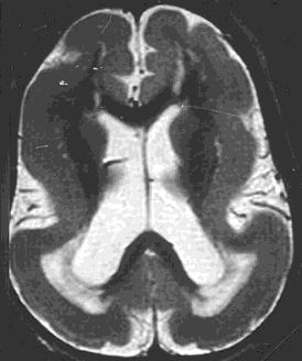 a neuronok a radiális