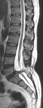 Zárt dysraphismusok subcutan massza nélkül: Diastematomyelia B. /B.