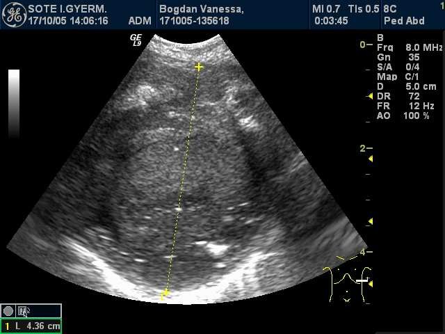 A BACTERIALIS PNEUMONIA SZÖVİDMÉNYEI Abscessus Empyema