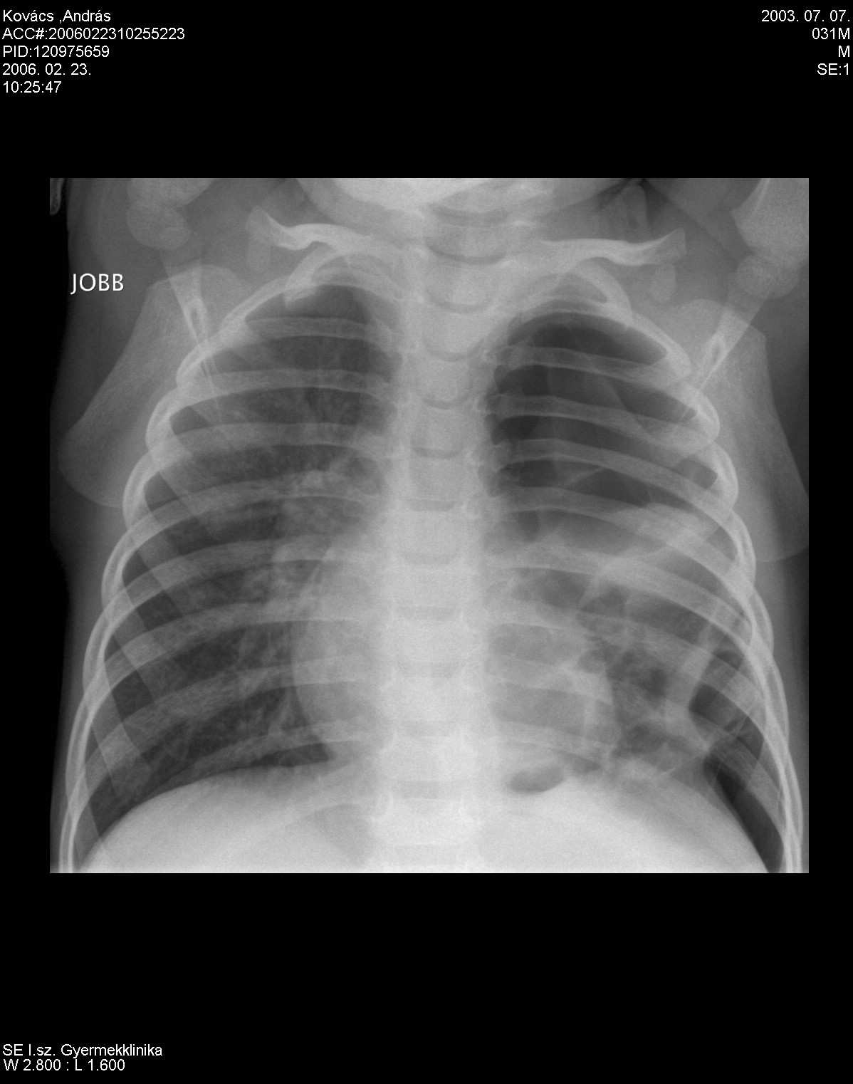 PNEUMATOCELE - Obstructiv (szelep-) mechanizmus, felfújódás - A gyógyulás