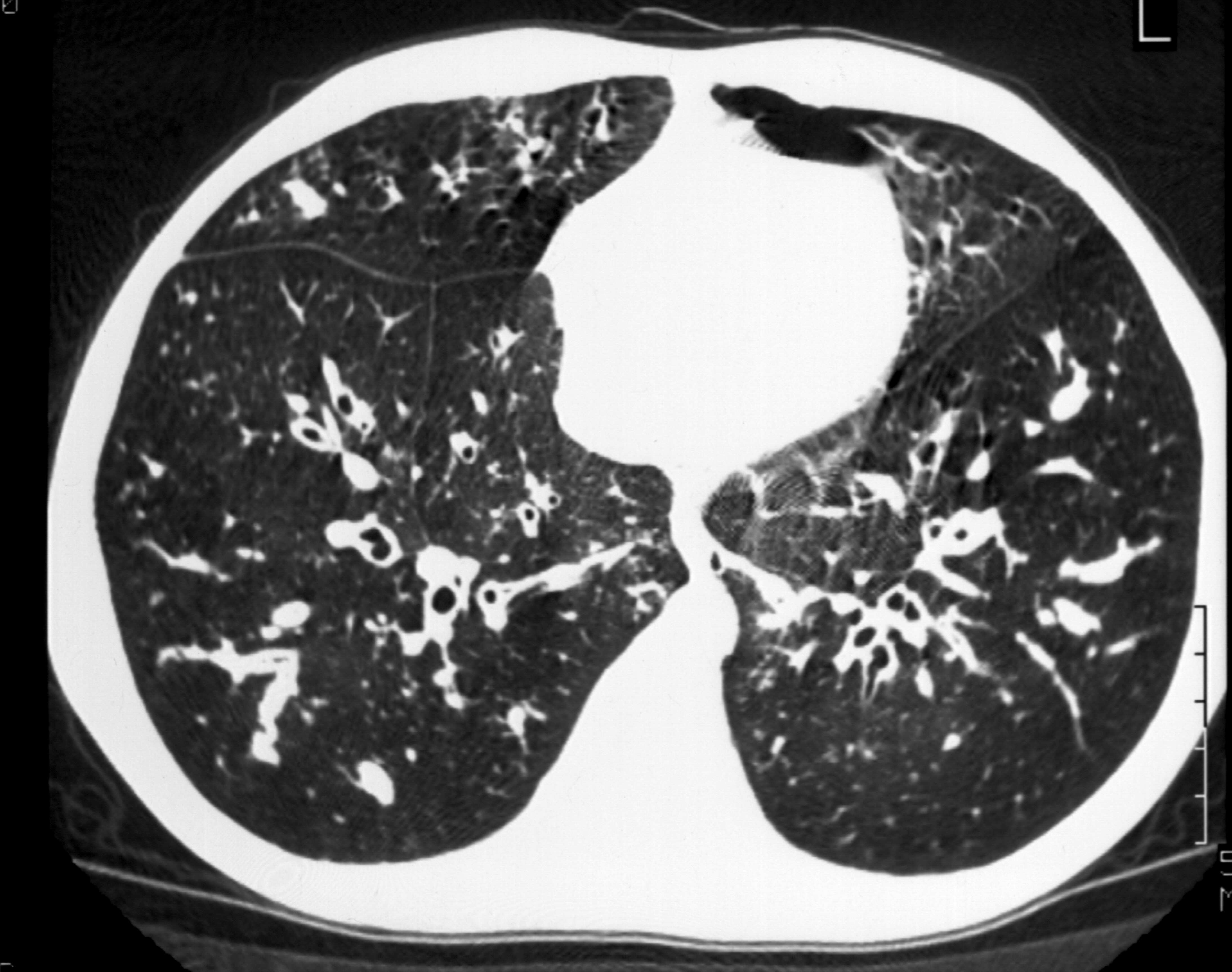 KRÓNIKUS TÜDİBETEGSÉGEK BPD Mucoviscidosis Histiocytosis Sclerosis