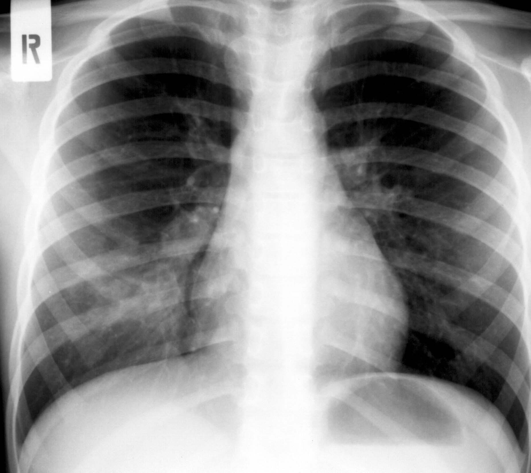 ASTHMA exacerbatiok között: normális mellkas rtg acut szak -szövôdmények kimutatása :