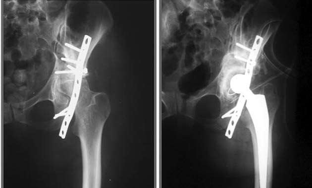 Poszttraumás arthrosis és centrális, 10 25 mm Ø