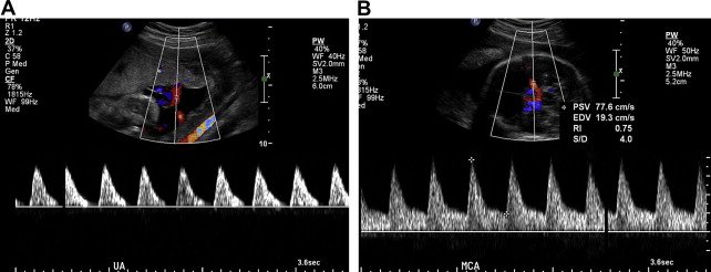 Ábra 3: Placentáris elégtelenség Doppler-flowmetriás jelei Magyarázat: (A) Diastolés blokk az arteria umbilicalisban (B) kompenzatórikus fokozott áramlás az arteria cerebri mediaban 3 A szuboptimális