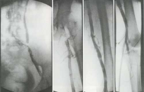 7 Megbeszélés Módszerünkben kétfajta kezelést kombináltunk: véna cava filter beültetése és intrathrombotikus lysis alkalmazása.