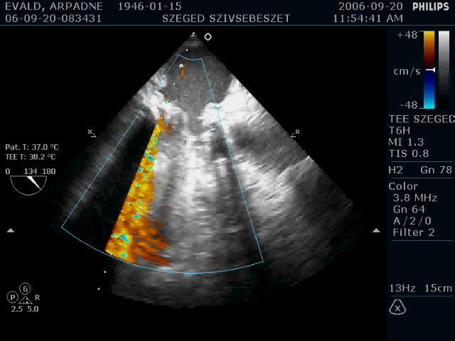 ECC hatások, XXL Endocarditis A megelőző szeptikus állapotból fakadó consumptio A leukocyta