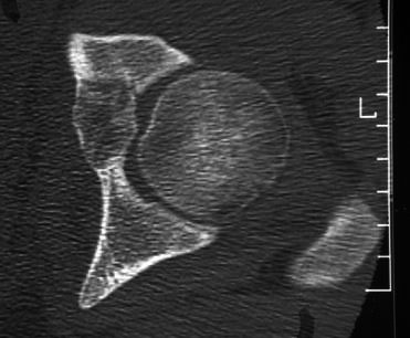 A 15 extraarticularis osteoid osteomás beteg közül 13-at ezzel a diagnózissal, két beteget krónikus osteomyelitis diagnózissal utaltak hozzánk, míg az intraarticularis csoportban csupán 7 betegnek