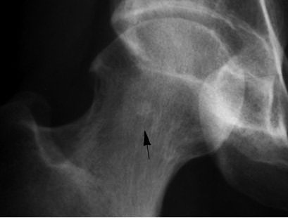 a b c 2. ábra 12. eset: Osteoid osteoma a femurfej/nyakban.