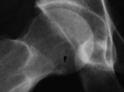 B: Lauenstein röntgenfelvételen jobban látható a nidus (nyíl).