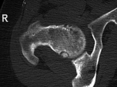 eset: Osteoid osteoma a talus nyakában.