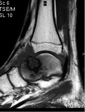 MEGBESZÉLÉS Az osteoid osteoma klasszikus megjelenése a röntgenfelvételeken, tünetei