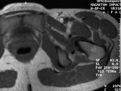 D: Az MRI felvételen kevésbé demonstratív az osteoid osteoma