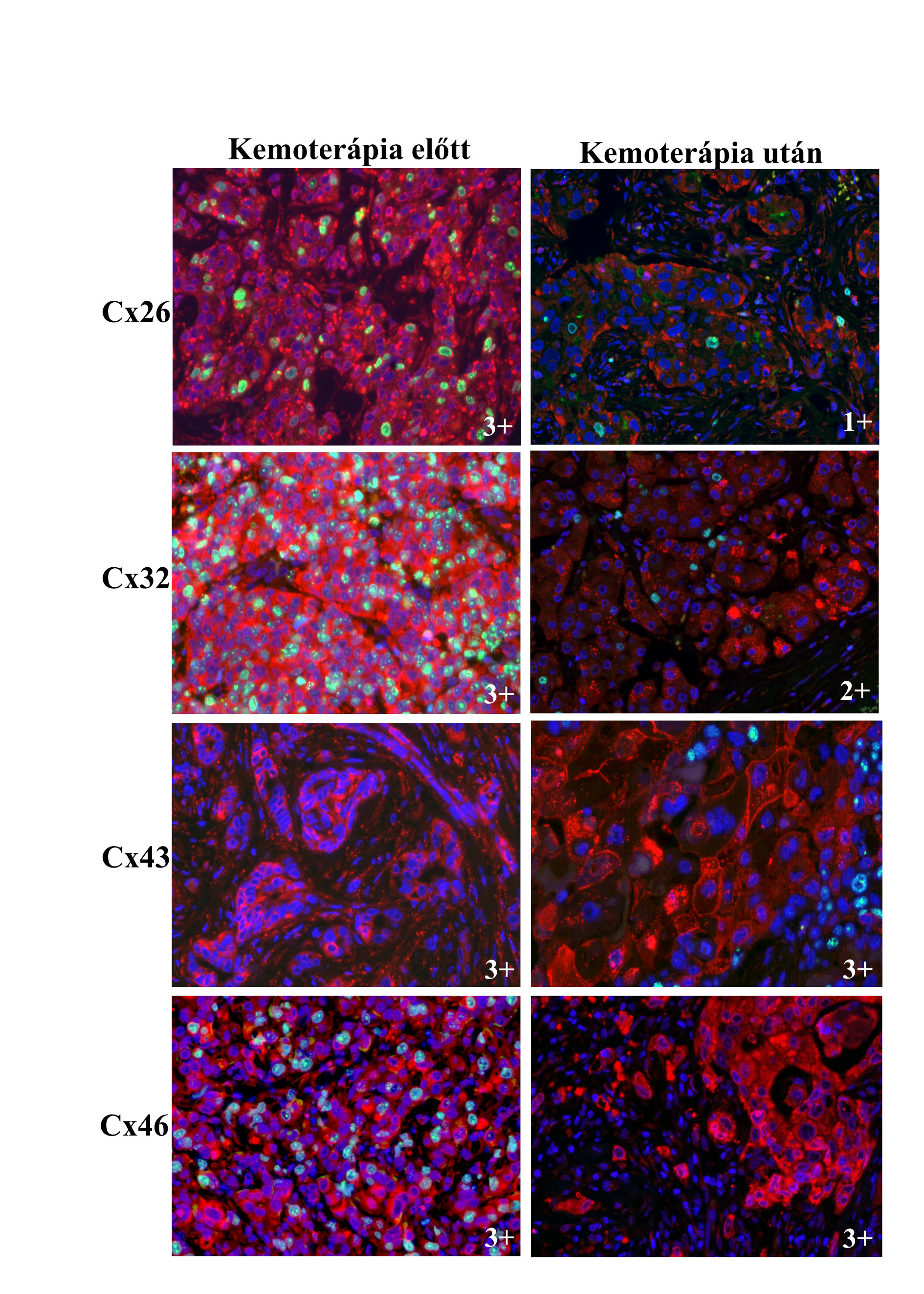 8. ábra. Cx26, Cx32, Cx43 és Cx46 (Alexa 546, vörös) és Ki67 (Alexa 488, zöld) fehérjék immunfluoreszcens detektálása invazív ductalis emlőrákokban neoadjuváns terápia előtt és után.