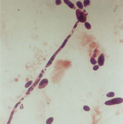 - Trichomonas vaginalis and soor (Candida albicans) positive vaginal