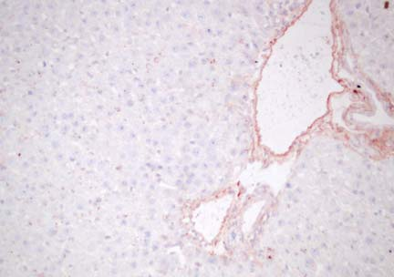 A B PT PT C D PT PT 13. ábra. Matrilin-2 fehérje immunhisztokémiai detektálása parciális hepatectomiával kezelt patkány májakon, PT-portális tér. A nyíl a pozitív reakciót jelzi. A. 24 órával a PH után, B.