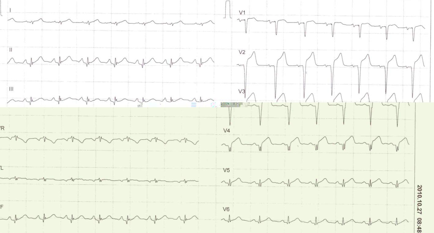 Írja be a kérdés szövegét... 1. normál variáns 2. pericarditis 3.