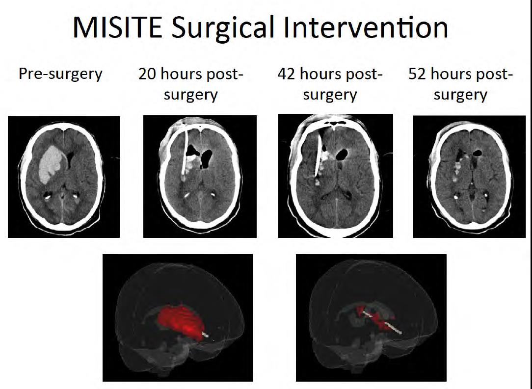 MINIMALLY INVASIVE SURGERY AND THROMBOLYSIS FOR ICH EVACUATION (MISTIE) over 10 years of preliminary research and clinical trials: MISTIE is a series of clinical trials: MISTIE II and MISTIE III