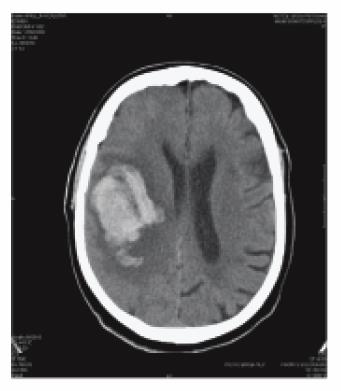 Intracraniális vérzés KVA kezelés mellett A vérzés