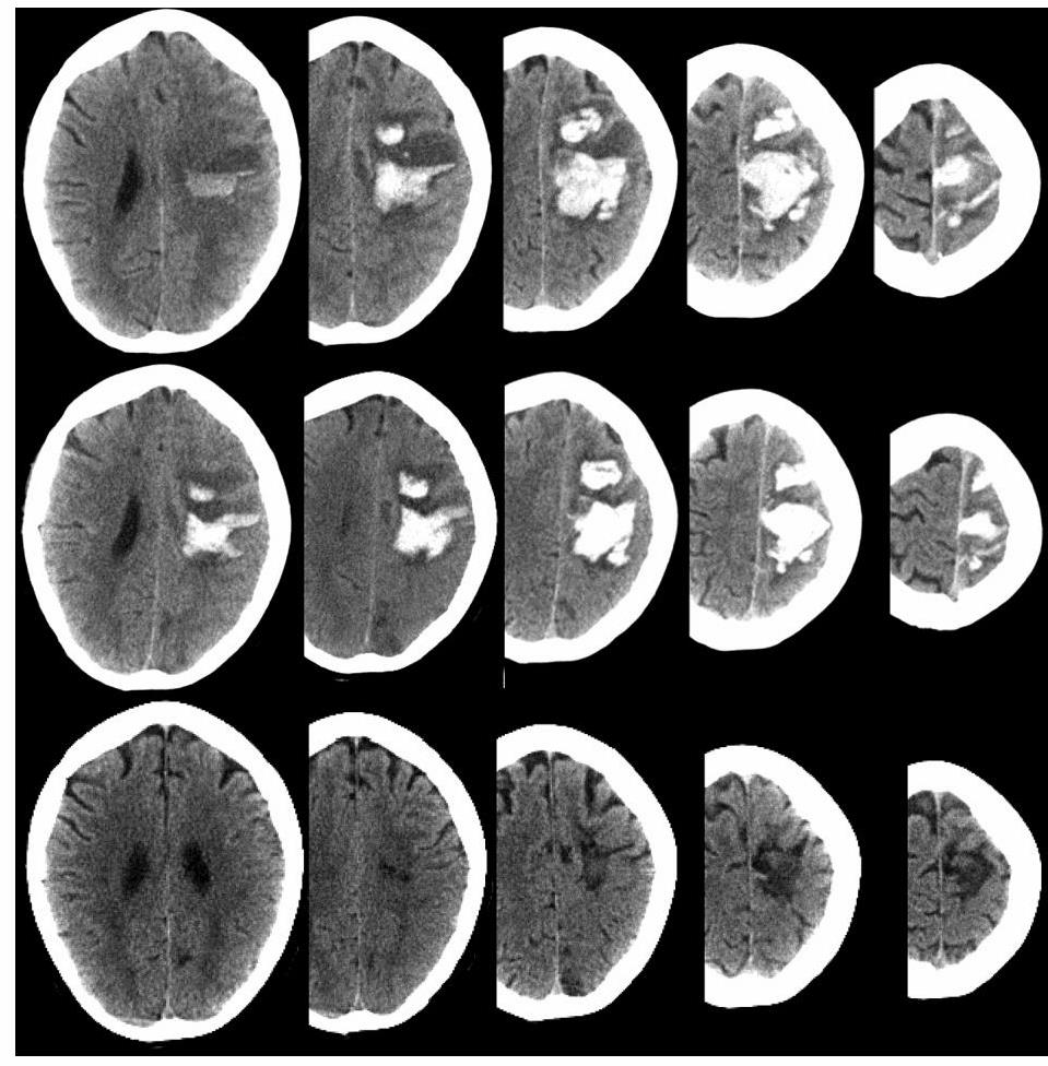 hét Kimenetel: NIHSS: 18 9 pont NIHSS: 33 22 pont Our cases demonstrate