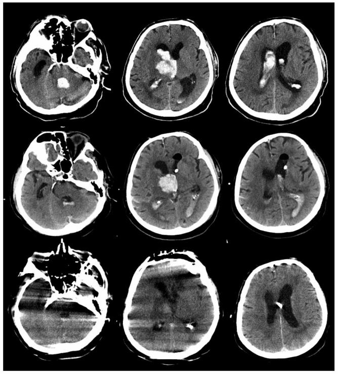 effectively counteracted by idarucizumab under real world conditions, thus