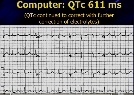 Hypokalaemia,