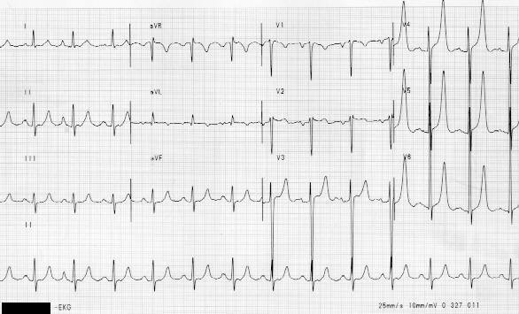 EKG 1.