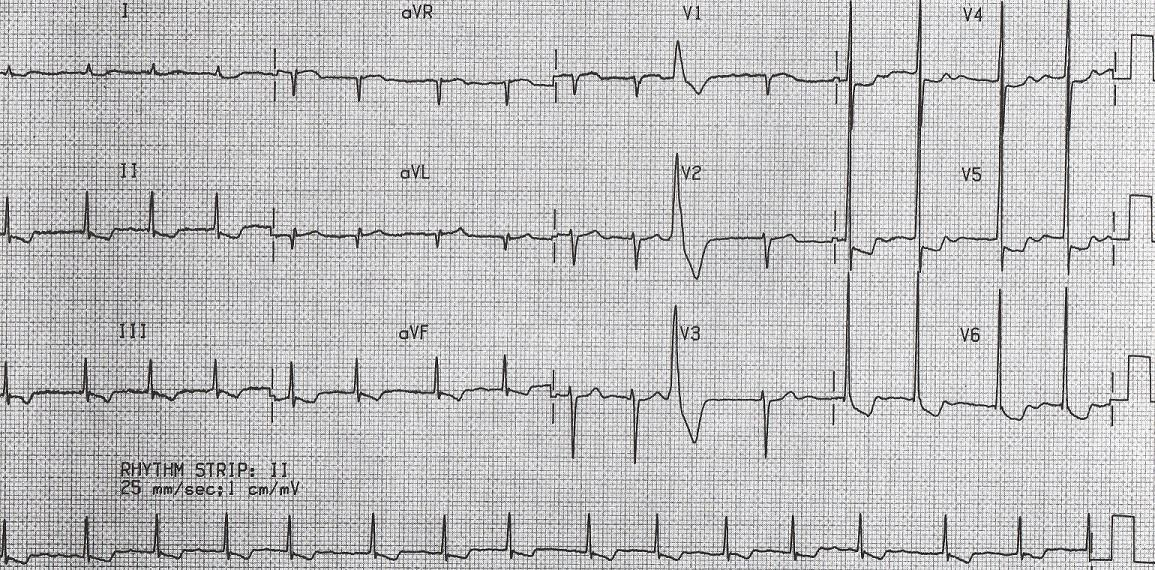 Digoxin toxicity QT = 260 ms (QTc = 320 ms), downward