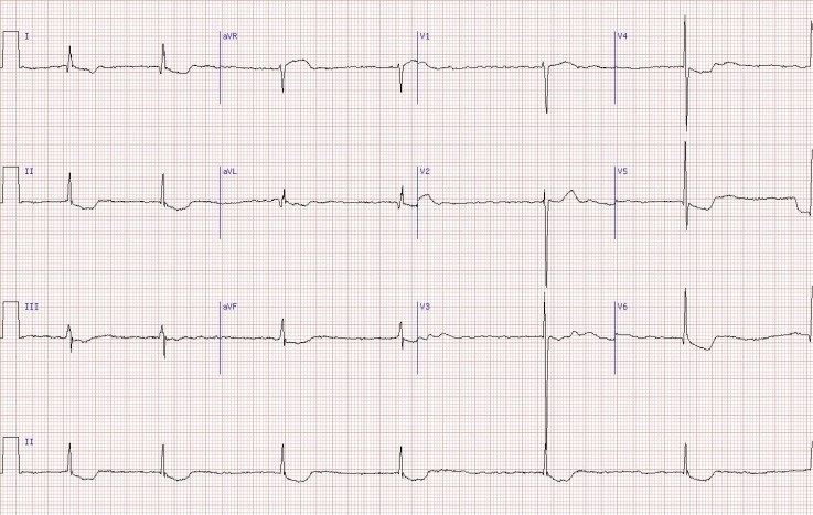 Digoxin