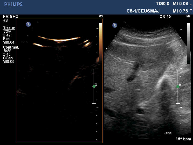 CEUS: 1 ml