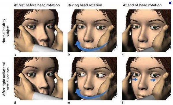 Horizontális fej-impulzus (Halmágyi) teszt VOR rövid, gyors fejfordítás, alany előre fixál patológiás válasz: kompenzatoros ( catch-up