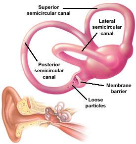 Benignus paroxysmalis pozicionális vertigo (BPPV) epidemiológia: prevalencia: 10.7-64/100.