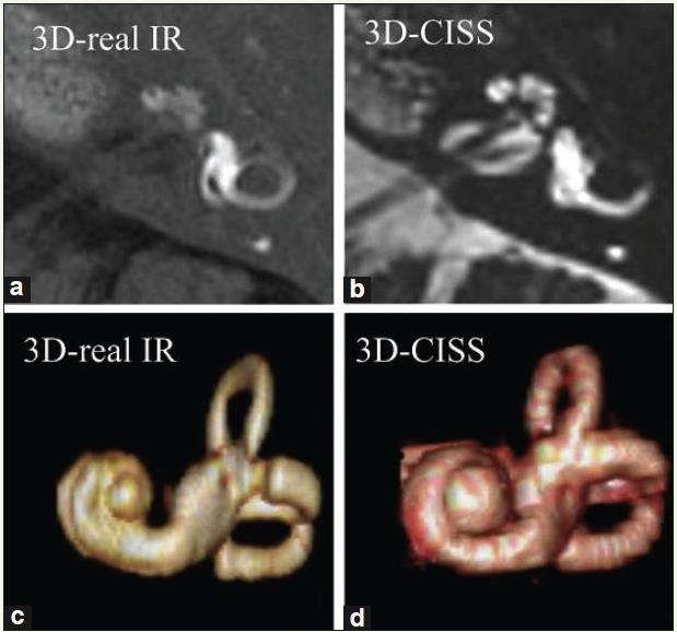 Meniere betegség (= endolympha hydrops) patofiziológia: endolimfa-zsákon belül nyomásfokozódás rohamokban jelentkező panaszok: (1) halláscsökkenés, (2) fülzúgás, (3) szédülés roham tartama: 2-3 óra,