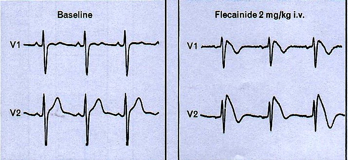 Spontán EKG változás 4