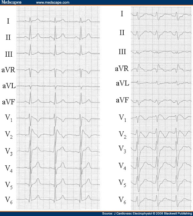 Alacsony Rizikójú Brugada QRS<120