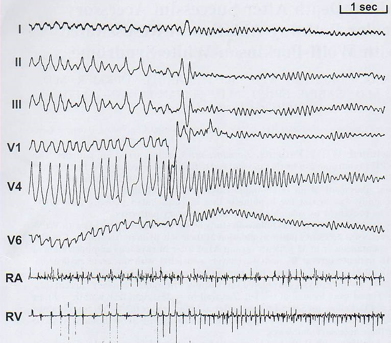 WPW s (FBI) tachycardia - KF Th: i.v.