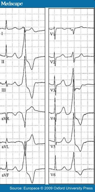 Bal sinus