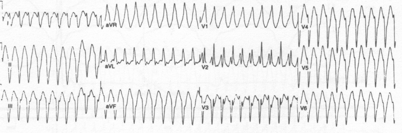 Bal posterior