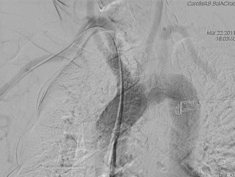 1. ábra. Aortográfia történik LAO30 irányból kevés kontraszttal (15 ml, 10 ml/sec), amelyen jól látszik a II. típusú aortaív. A bal ACC nagyon közel ered az arteria anonymához 2. ábra. Anteroposterior (AP) (2A) és teljes oldal (LAO90º) (2B) felvételek történnek a nyaki és az intracranialis szakaszról 3.