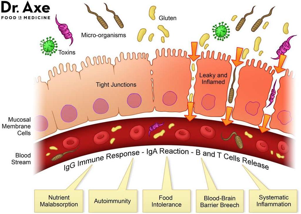 Áteresztő bél (béldiszbiózis, IBS) glutén mikroorganizmusok toxinok szoros illeszkedés lyukas és gyulladt nyálkahártya membrán sejtek véráram reakció