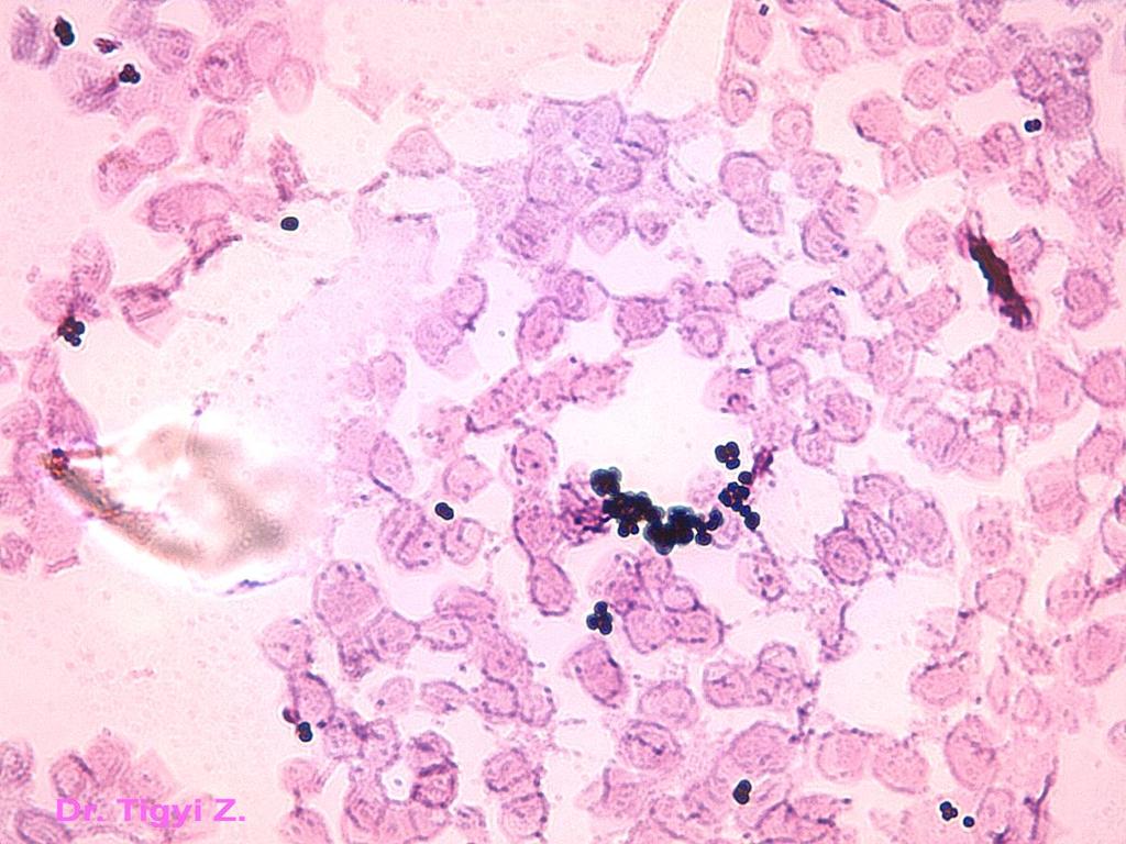 BACTERIAL SMEARS STAINED ACCORDING TO GRAM Gram (+) cocci can be seen