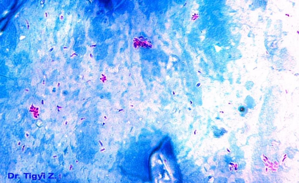 Ziehl-Neelsen or acid fast staining Mycobacterium tuberculosis bacteria in a sputum from a patient having open tuberculosis.