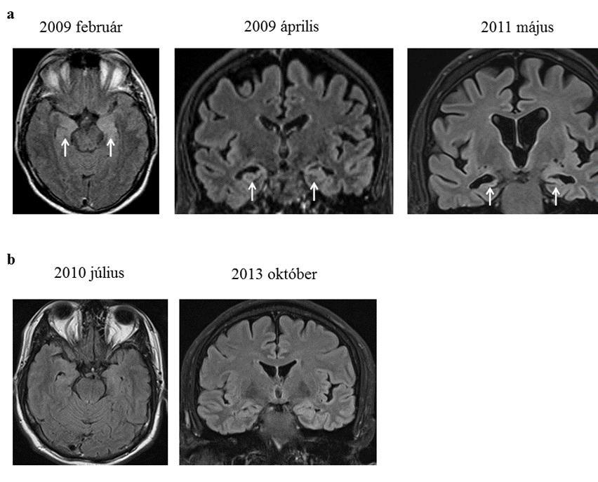 A Huszonhét hónapos MRI követés. A FLAIR-súlyozott axiális képeken (0,5 T) bilaterális hippocampalis ödéma látható (akut fázis, 2009) (nyilak).