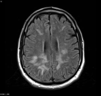 Központi idegrendszert érintő lymphomák (1) A központi idegrendszert érintő non-hodgkin lymphomák ritkák. Három úton lehetséges kialakulásuk: 1.