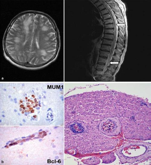 Intravascularis lymphoma Az IVL ritka volta miatt egy orvos egész praxisa alatt csupán pár beteggel találkozhat.