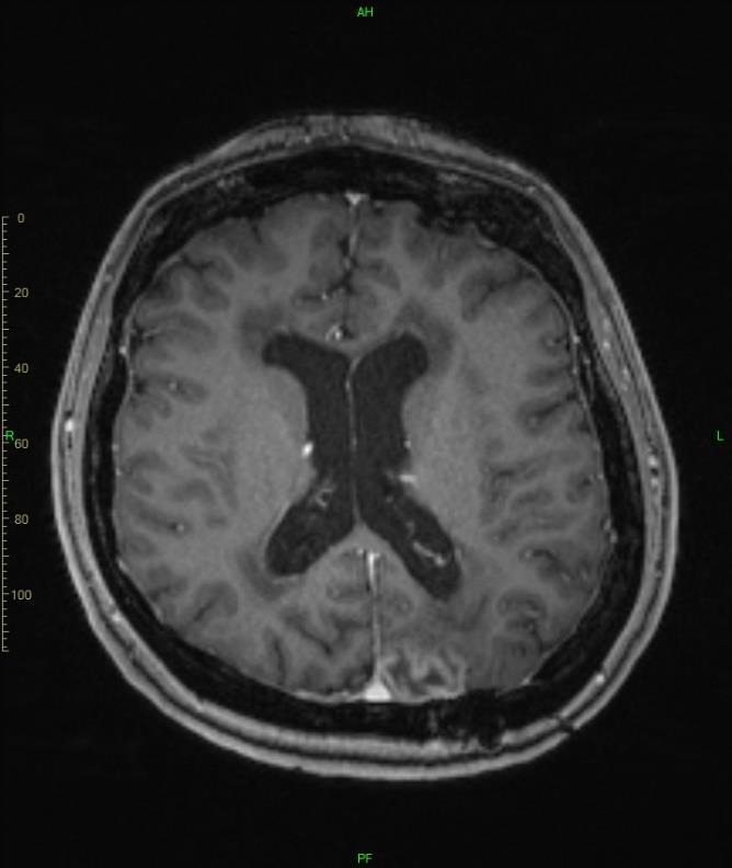 2010- ben látjuk elő alkalommal klinikánkon beszédzavar, jo-i hemianopia, jo-i enyhe hosszúpályatünetek - MR bo-i occipitalis lebenyben,